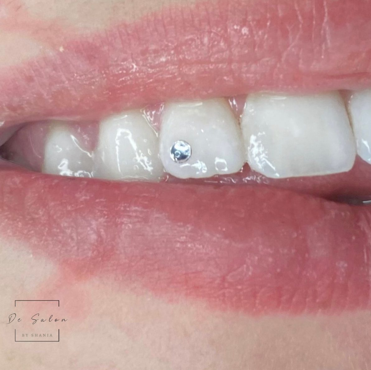Een Swarovski tandkristal op een voortand